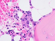Multiple Myeloma - Large Plasma Cells - 5.