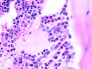 Multiple Myeloma - Large Plasma Cells - 6.