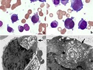 Erythroid leukemia mimicking megakaryocytic leukemia