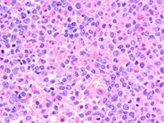 AML with inv(16) - 6.