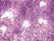 Precursor T-cell ALL - 5.