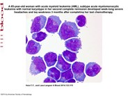 Acute myeloid leukemia relapse first presenting in the cerebrospinal fluid