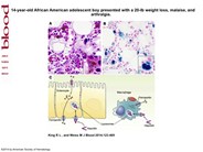 Iron-laden macrophage in autoimmune disease