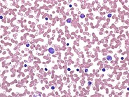 Juvenile Myelomonocytic Leukemia - 1.