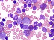 Juvenile Myelomonocytic Leukemia - 10.