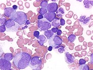 Juvenile Myelomonocytic Leukemia - 11.