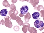 Juvenile Myelomonocytic Leukemia - 2.