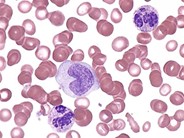 Juvenile Myelomonocytic Leukemia - 3.