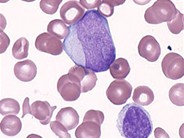 Juvenile Myelomonocytic Leukemia - 4.