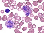 Juvenile Myelomonocytic Leukemia - 7.