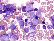 Juvenile Myelomonocytic Leukemia - 8.