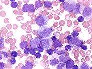 Juvenile Myelomonocytic Leukemia - 9.