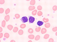 sezary cells