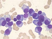plasma cell leukemia