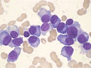 Plasma Cell Leukemia - 1.