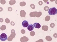 Plasma Cell Leukemia - 2.
