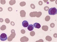 plasma cell leukemia