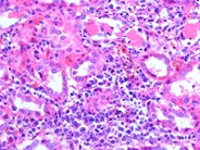 Plasma Cell Leukemia - 4.