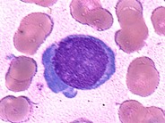 Dysplastic Erythroid Precursor - 1.