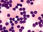 Chronic Lymphocytic Leukemia 2.