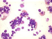 Refractory Anemia with Excess Blasts - 1.