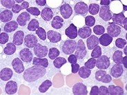 Chronic Lymphocytic Leukemia 2 