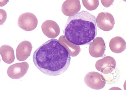 Prolymphocytic Leukemia - 3.