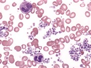 Essential Thrombocythemia - 1.