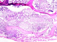 Sarcoidosis - 1.