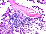 Sarcoidosis - 2.