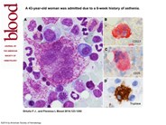 Giant multilobated mastocytes (promastocytes) in the setting of a refractory acute myeloid leukemia with myelodysplasia-related changes and monosomal karyotype
