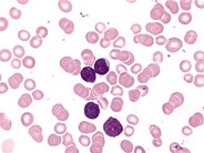 ALL - Peripheral Smear - 1.