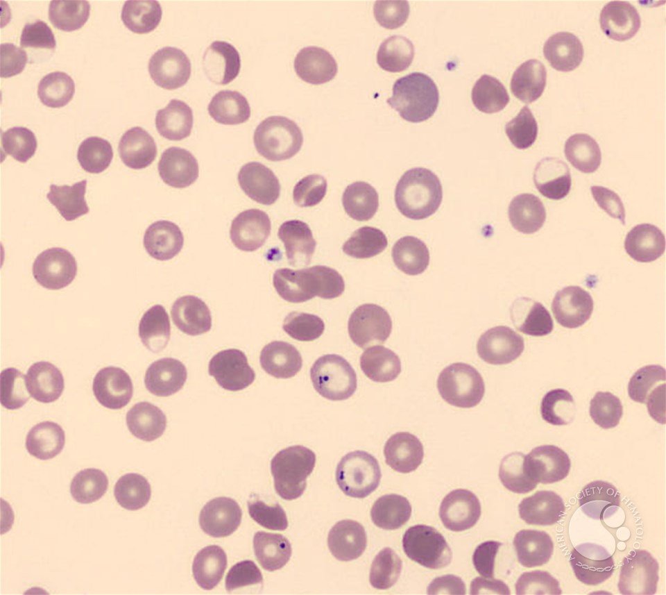 Hemoglobin S blister cell variant