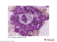 Blastic island in acute myeloid leukemia