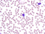 NK Cell Lymphocytosis - 2.