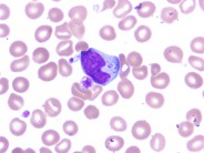 NK Cell Lymphocytosis - 8.