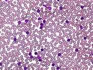 T-cell Prolymphocytic Leukemia - 1.
