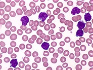 T-cell Prolymphocytic Leukemia - 2.