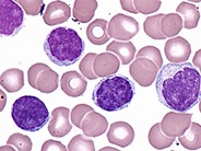 T-cell Prolymphocytic Leukemia - 3.