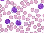 T-cell Prolymphocytic Leukemia - 4.