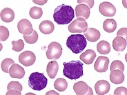 T-cell Prolymphocytic Leukemia - 5.