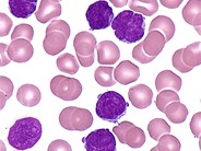 T-cell Prolymphocytic Leukemia - 6.