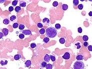 T-cell Prolymphocytic Leukemia - 7.
