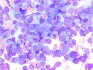 Undifferentiated Metastatic Neuroblastoma 2