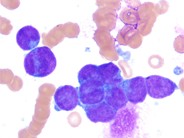 Undifferentiated Metastatic Neuroblastoma - 4.