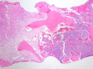 Undifferentiated Metastatic Neuroblastoma - 5.