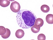 Atypical Lymphocytes With Azurophilic Granules