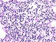 Rituximab-Associated Marrow T-cell Hyperplasia - 2.