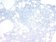 Rituximab-Associated Marrow T-cell Hyperplasia - 3.