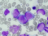 AML with mutated CEBPA